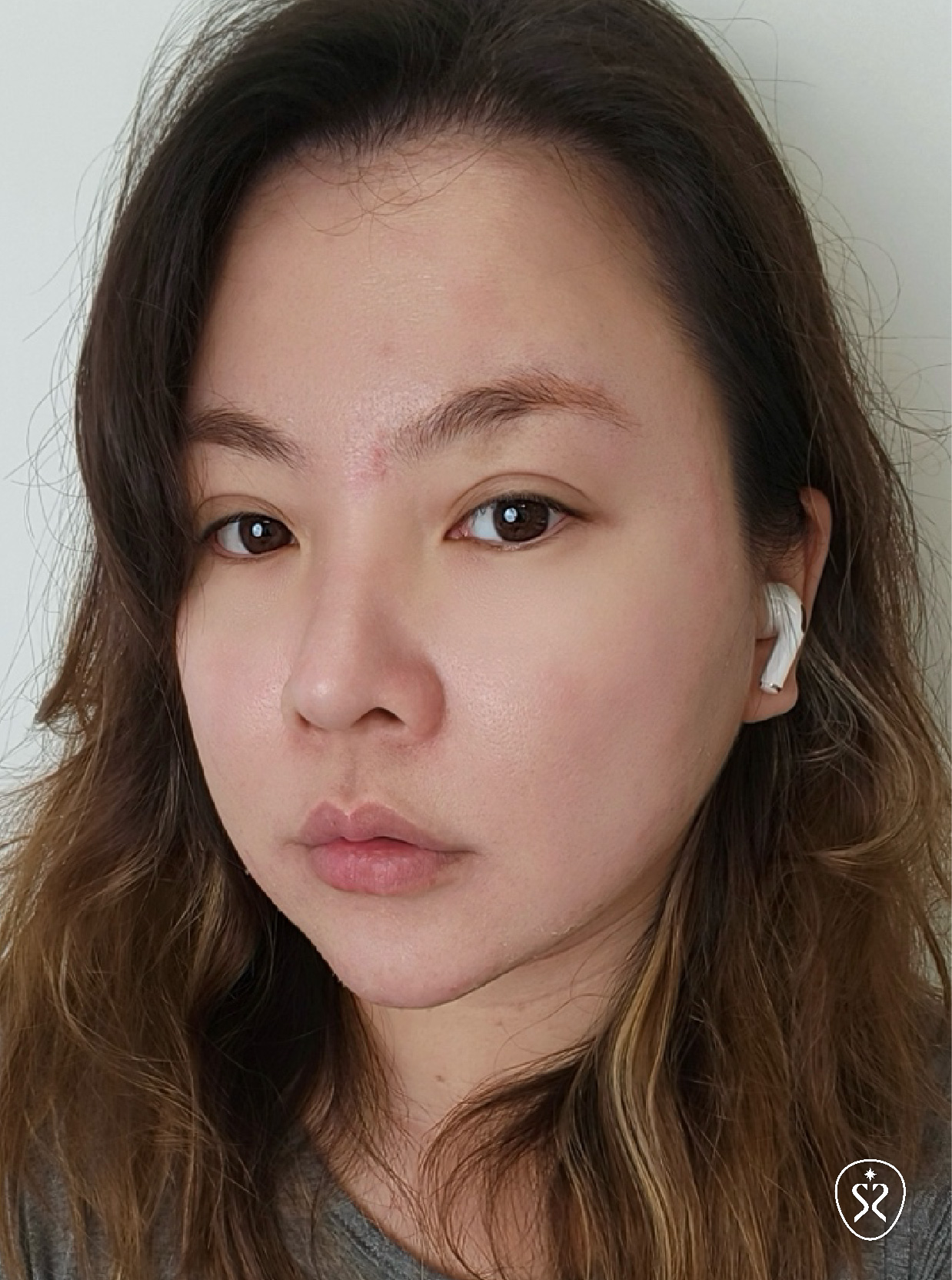 鳳凰電波術後近三個月臉部澎潤且線條立體